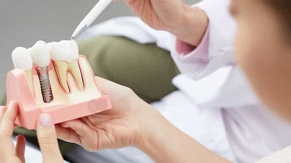 De ce implanturile dentare reprezintă viitorul înlocuirii dinților